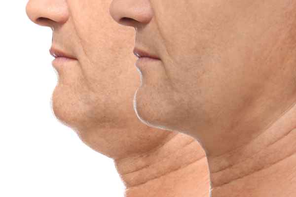 HIFU - Breakthrough in Anti - ageing 2 hifu results Camberley