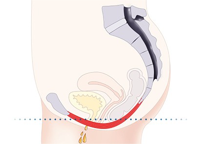 Pelvic-Floor Muscle Repair 5 Pelvic floor muscles Camberley