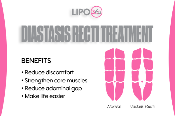 Revolutionising Muscle Repair: The Power of LIPO360 Body Sculpt Post-Injury 5 diastasis recti treatment Camberley