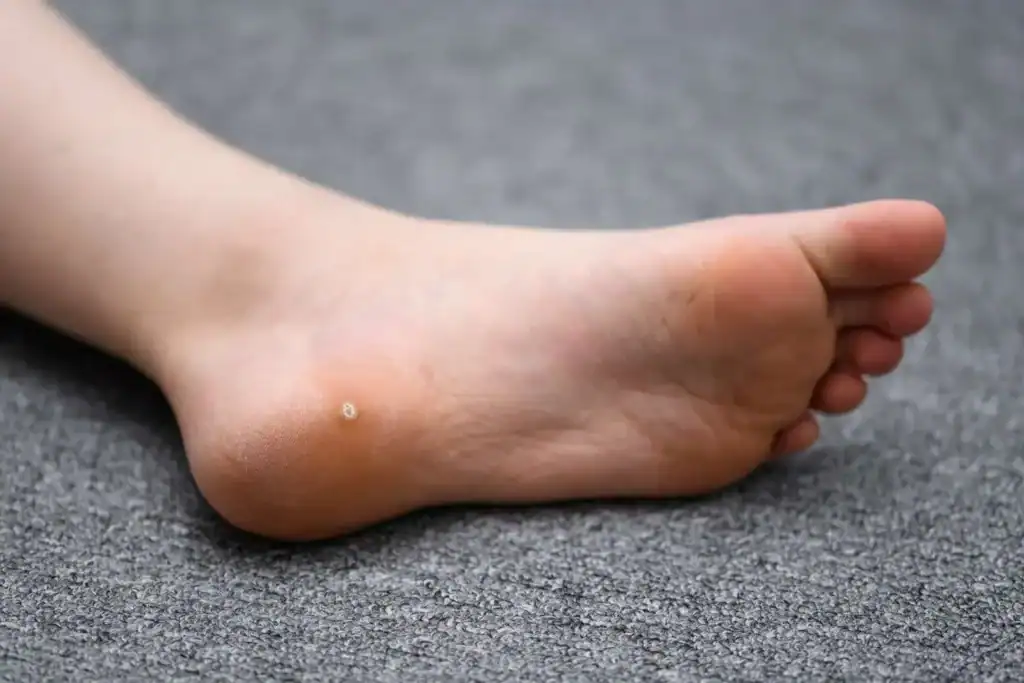 Cryotherapy For Warts And Also Verrucas 2 Image of verruca on the bottom of the foot that able to be treated with Cryotherapy Camberley