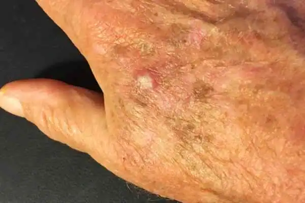 Image of Actinic keratoses Camberley on a person hand
