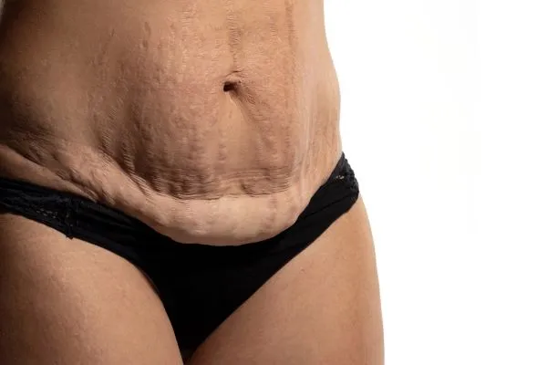The science behind skin tightening Camberley picture of a woman's sagging skin on the stomach